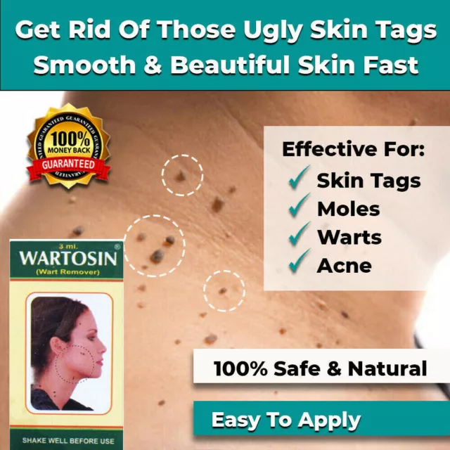 New Safe & Fast Skin Tag Remover Liquid Mole Wart Acne Pimple Patch Removal Spot