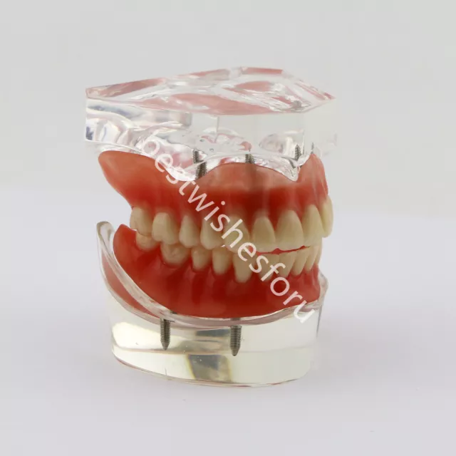 Superior Upper & Inferior Lower Dental Tooth Model Overdenture 4 Implants Demo