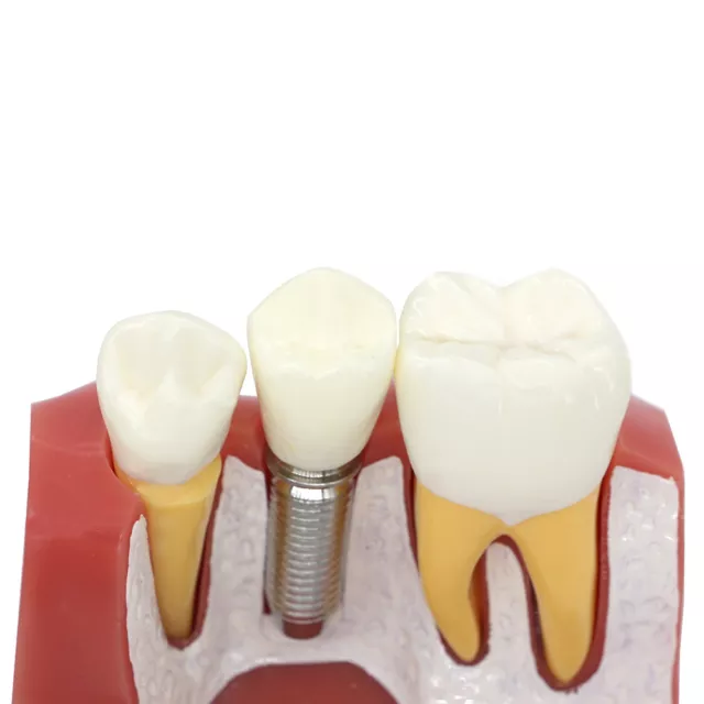 Dental Implant Analysis  Crown Bridge  Demonstration  Teeth  Model for Education