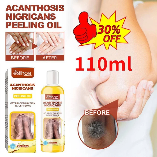 Olio esfoliante Acanthosis Nigricans 110 ml DE