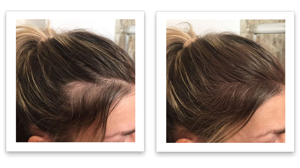 Febron Hair Building Fibers Hair Loss Concealer Thin Hair Solution