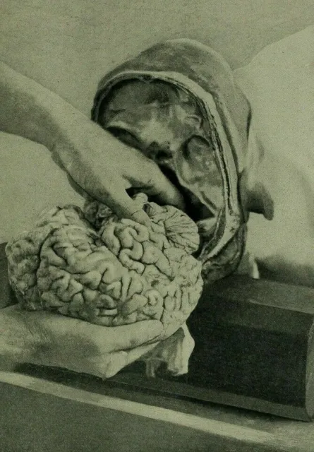 Antique Medical Autopsy Photo 499b Oddleys Strange & Bizarre
