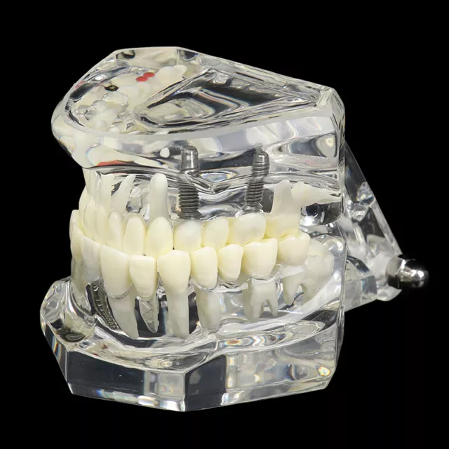 Dental Model Teeth Implant Restoration Bridge Teaching for Study Tooth Scien  ~'