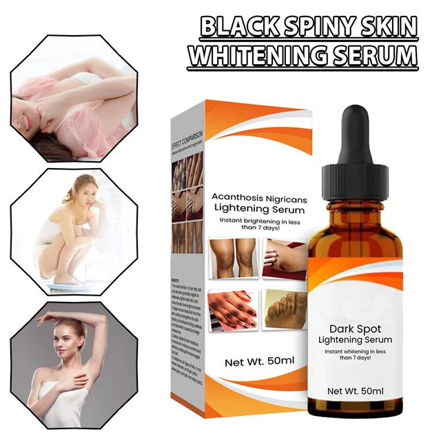 Acanthosis Nigricans Lightening Serum Treatment Oil Dark Knees Elbows C