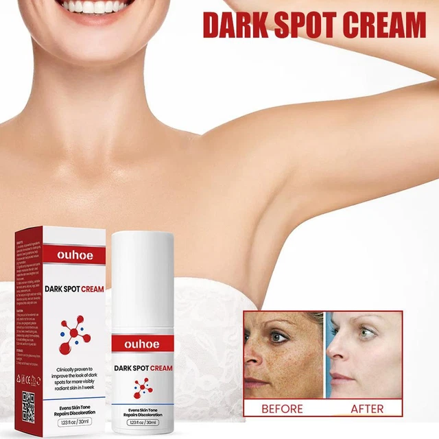 VENTA DE AZADA crema para manchas oscuras.
