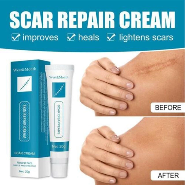Body Care Reduce Chirurgia Acne migliore crema rimozione cicatrici per cicatrici cura della pelle