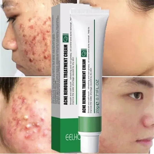 New Effective Acne Removal Cream Acne Treatment Skin Whitening Pimple Acne Cream