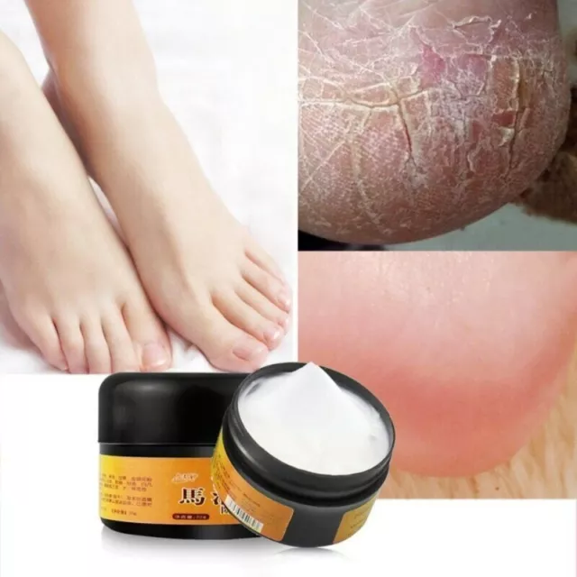 Crema Para Los Pies Manos Puedes Remover La Resequedad Y Las Grietas RAPIDAMENTE