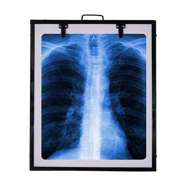 Xray view Box Digital for Clinic LED Single Film with Brightness control