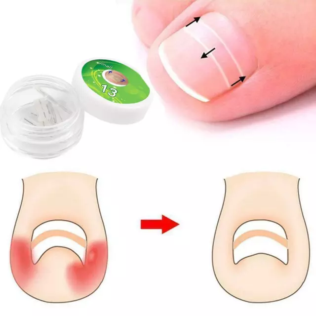 10x Ingrown Toenail Treatment Liner Ingrowing Toe Nail