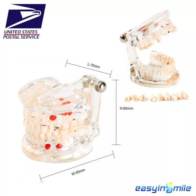Easyinsmile Dental Study Teeth Model Transparent Pathological Disease Tooth 1Pc