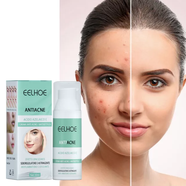 Akne Creme Anti Pickel Entferner unreine Haut Acne Mitesser Makel Entfernung