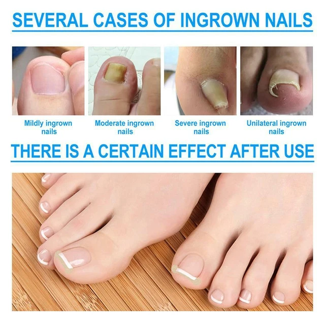 INGROWN TOENAILS BAND Aid Relief Pain Paronychia Correction Pedicure