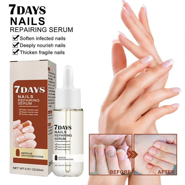 Nagel Hell Serum Recover Pilze Maniküre Repair Öl Zehennagel Pflege Gesundheit ]