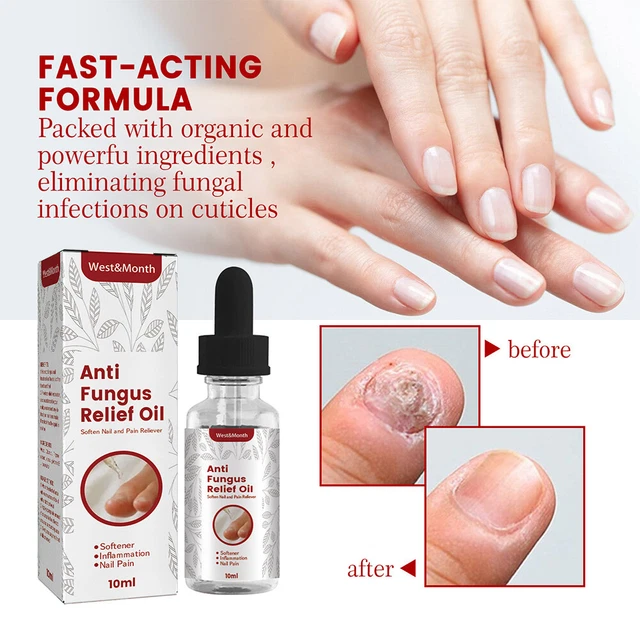 Anti infezioni siero unghie riparazione olio recupero funghi cura unghie cura unghie E