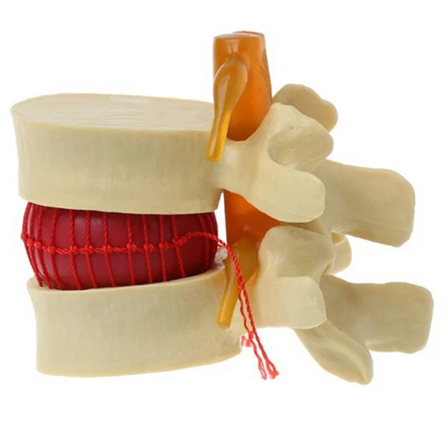 Modello Anatomico Colonna Lombare 1.5X – Ernia Del Disco E Vertebre In PVC, Per Studio Medico E Comunicazione Con Pazienti - 5