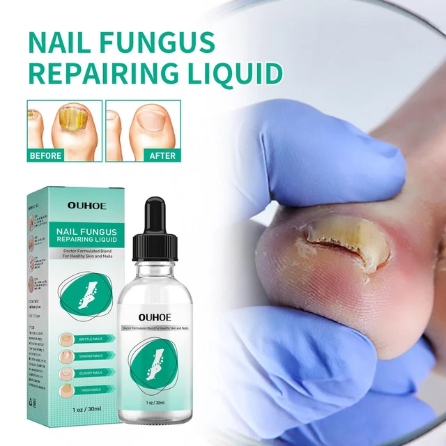 Kerassentials For Toenail Fungus Kerassentials Toenail 30ml Oil Fungus A7N3