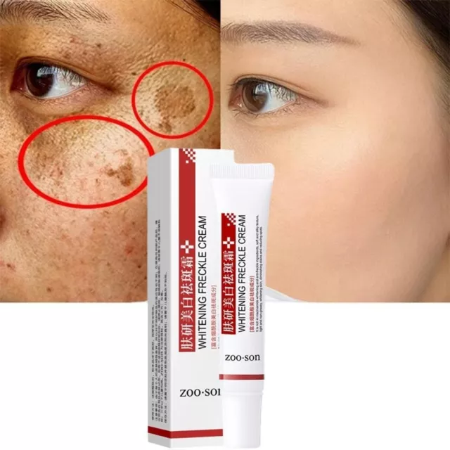 Whitening Freckle Cream Remove Dark Spots Anti Freckle Cream Niacinamide Fade