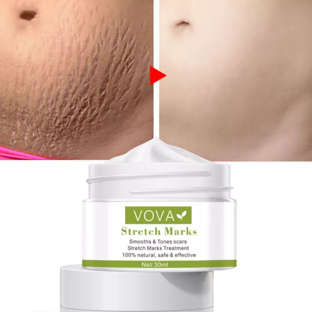 Stretch Mark Removal Repair Cream For Postpartum Pregnancy Scar Skin Care AU