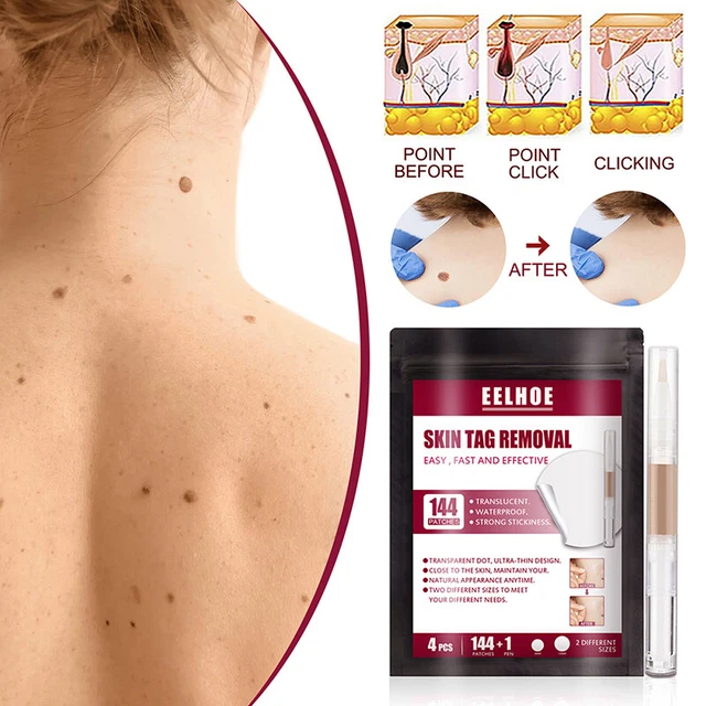 Accessorio Sanitario Comodo Etichetta Pelle Verruca Pasta Rimozione Per Donna RODE