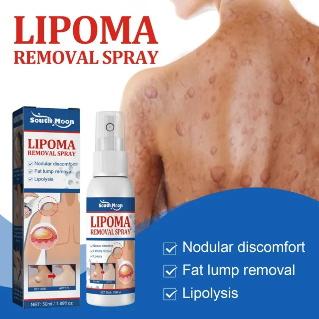 LumpFree Lipoma Instant Lipom Entfernung Spray Lipomheilung Reduktionsspray