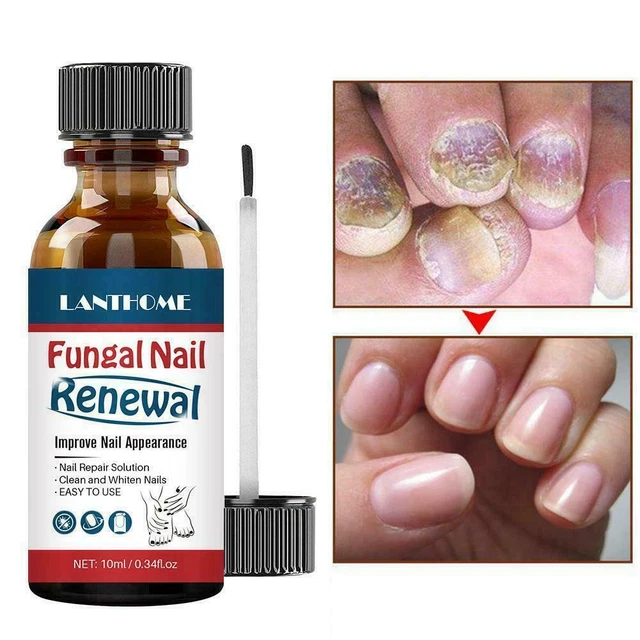 NAIL REPAIR ANTI Fungal Nail Infection Onychomycosis Paronychia