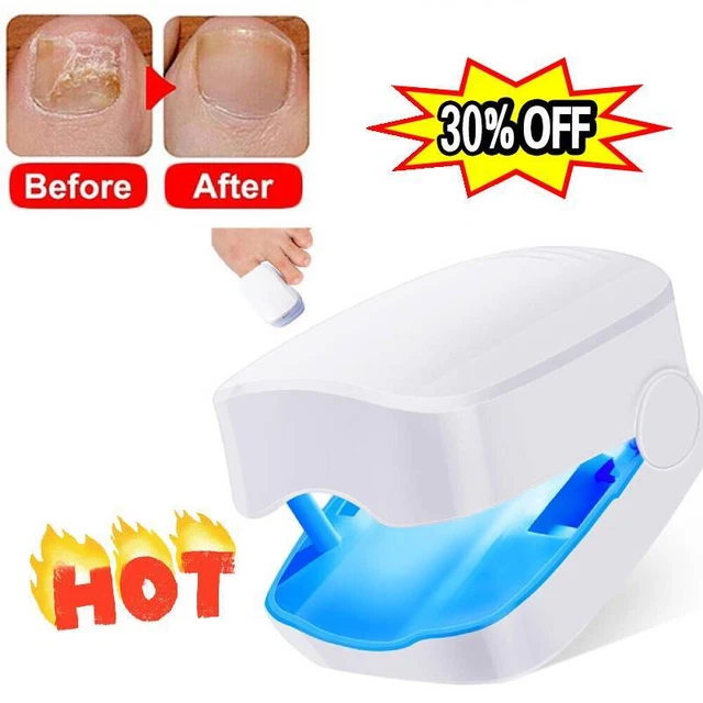 NAIL FUNGUS LASERDEVICE, Anti Fungal Treatment Laser Devicefor