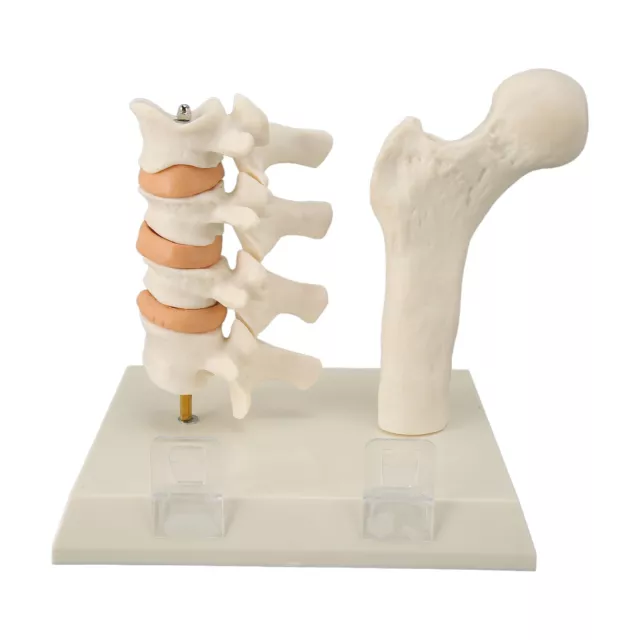 Modèle De Colonne Vertébrale D'ostéoporose Démontrant Le Mode De Lésion D'ostéop