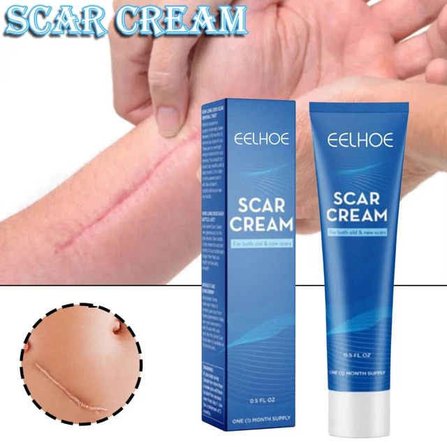 Gel rimozione crema cicatrici rimozione smagliatura smagliatura cura chirurgica acne riparazione pelle +