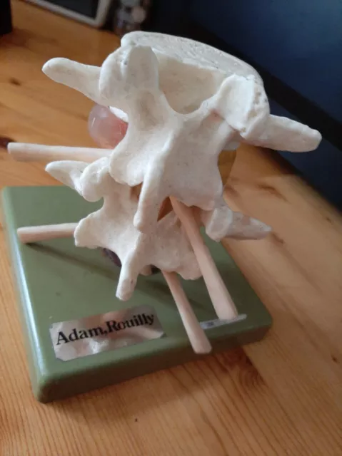 Model of Vertebrae showing ruptured disc and nerves.Made by Adam Rouilly Plastic