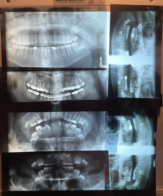 VINTAGE ORTHODONTIC XRAYS Lot of 18 JAW TEETH Oddity 1970’s 14.00 PicClick
