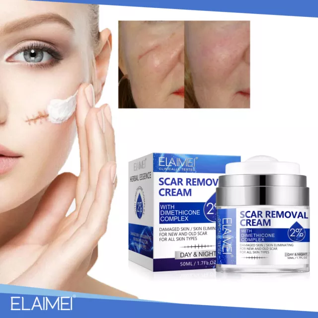 Acne Scar Removal Cream Ointment Treatment Stretch Mark Spots Skin Care Face AU