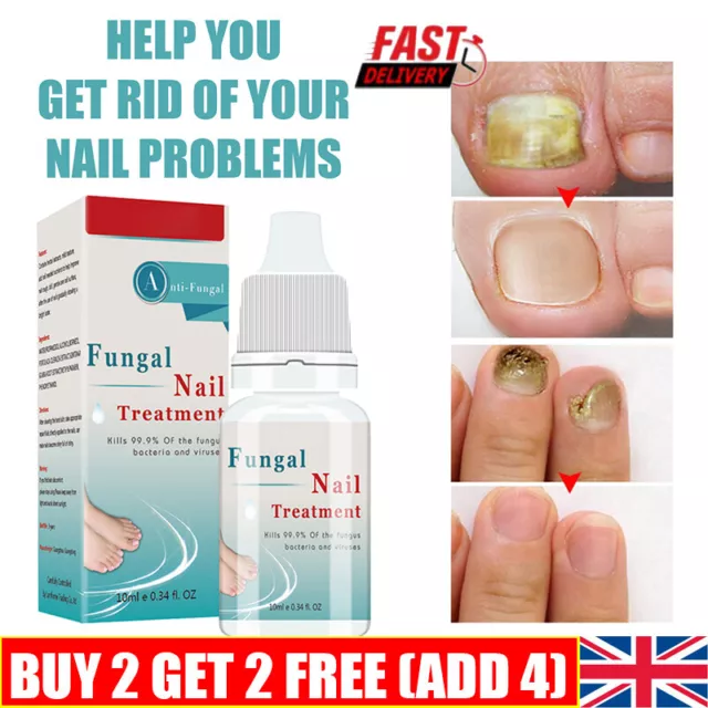 10ml Fungal Nail Treatment Liquid HIGHLY EFFECTIVE KILLS TOE NAIL FUNGUS