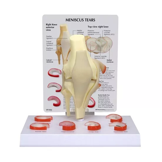 Knee Joint GPI Anatomical Model Meniscus Tears  LFA#1010 Make Us An Offer! VIDEO