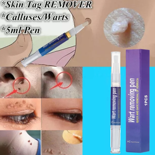 Wirksamer Warzenentferner Stift Skin Tag Mole Remover Beseitigt Hornhautwarzen