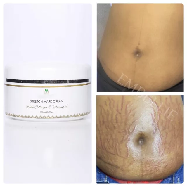 Stretch Mark Remover Cream