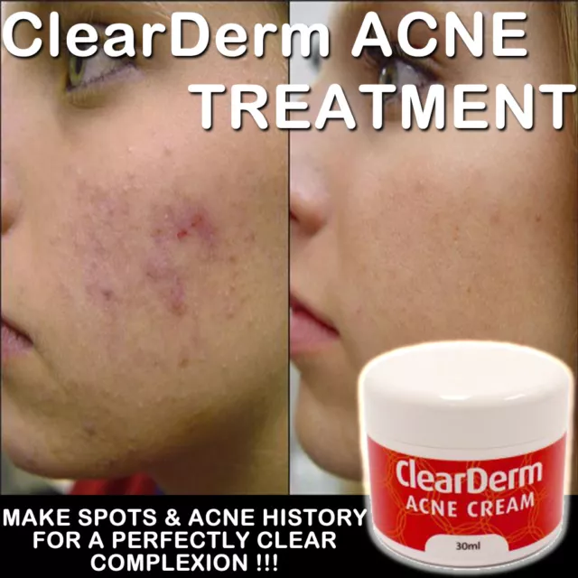 Clearderm Acne Cream Lotion High Strength Natural Ingredients Clear Skin !