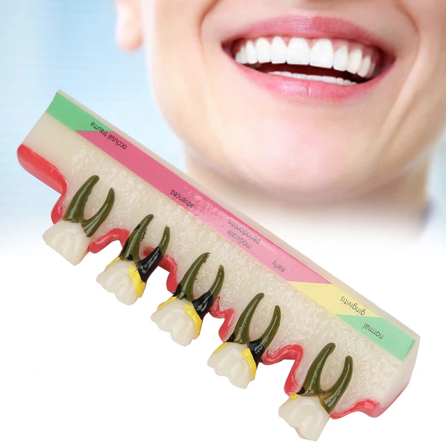Modèle D'enseignement Dentaire - Maladie Parodontale Et Classification Des Dents