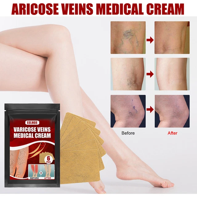 Body Vasculitis Phlebitis Spider Pain Relief Plaster Unisex Health Care Patches 5