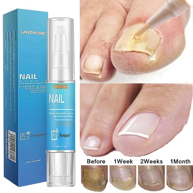 PARONYCHIA ANTIFUNGAL NAIL Fungal Treatment Nail Repair Serum