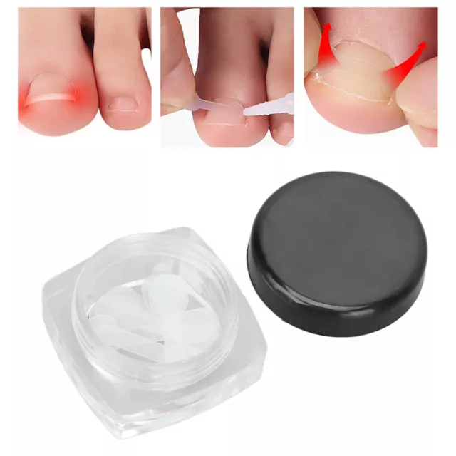 (Light Strength)10pcs Ingrown Toe Nail Correction Strips Painless AGS