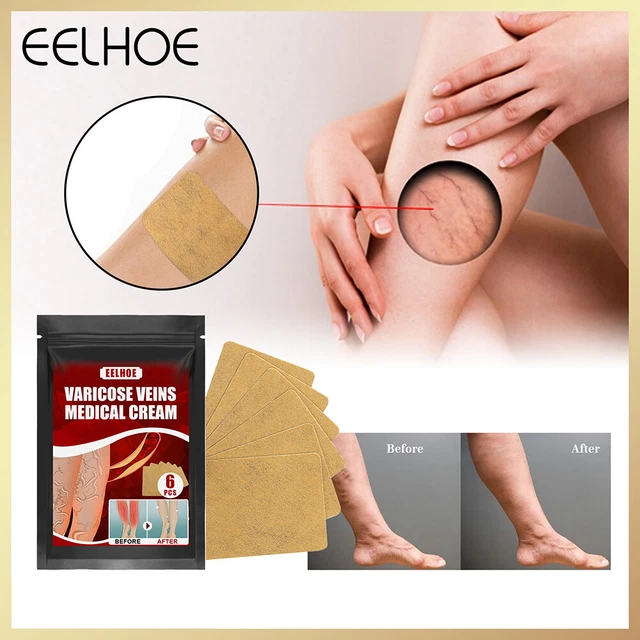 Body Vasculitis Phlebitis Spider Pain Relief Plaster Unisex Health Care Patches 2