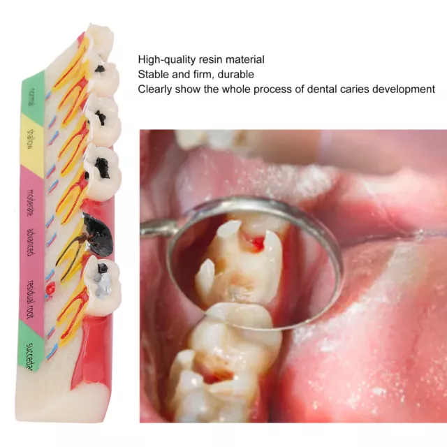 Dental Caries Developing Model Portable Decayed Teeth Model For Dental Teach HPT