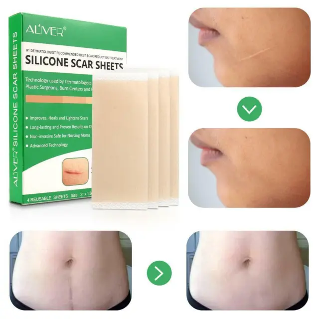 ALIVER Medical Silicone Gel Strips Patch Scar Away Tape Sheet Treatment T1T2