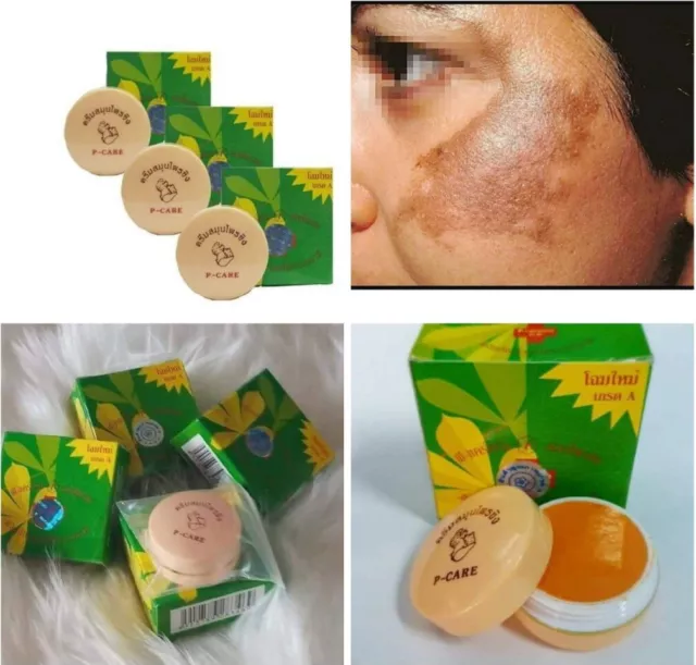 P-CARE Ginger herbal cream for acne, melasma, freckles . ( 2 Stück)