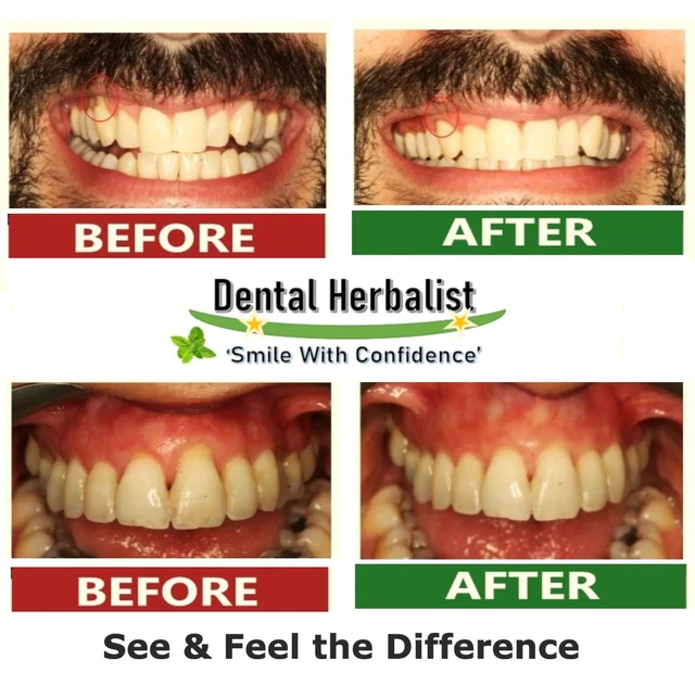 FIRST AID FOR BLEEDING GUMS Stop Gum Infection & Inflammation Organic