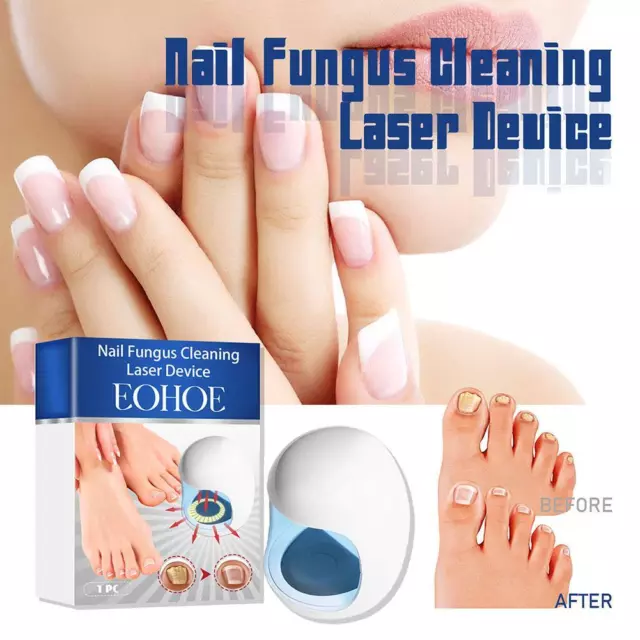 Nail Fungus Cleaning Cold Laser Device Home Treatment For Fungal Nails