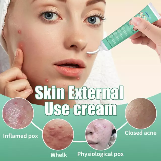 Effective Acne Removal Cream Treatment Pimple Scar Mark Spot Face Gel Skin Care