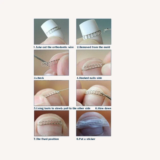 Autocollants de correction des ongles incarnés Outils de soins des pieds de