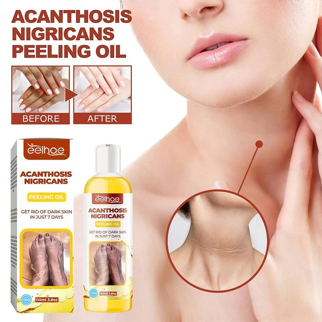 Correttore macchie scure nocche scure ginocchio sbiancamento acantosio nigricans olio terapia